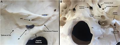 Microsurgical Anatomy of the Jugular Foramen Applied to Surgery of Glomus Jugulare via Craniocervical Approach